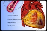 What are symptoms of a Heart Attack?